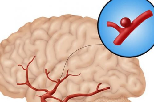 аневризма головного мозга